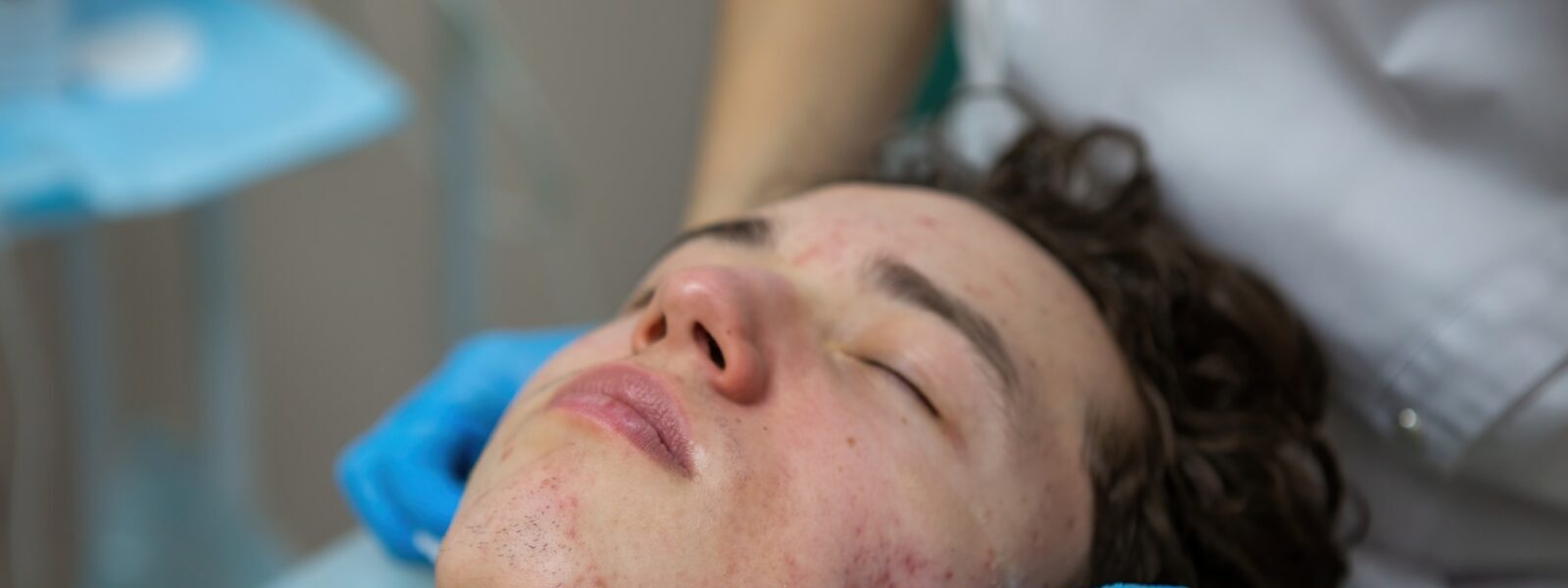 Treatment of acne in adolescents. Facial peeling to fight acne on the face