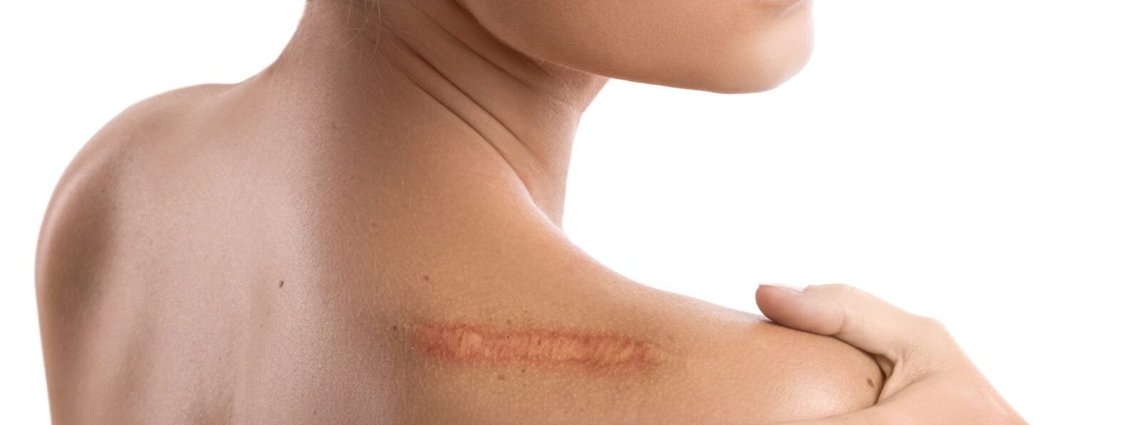 Woman with a scar on her shoulder